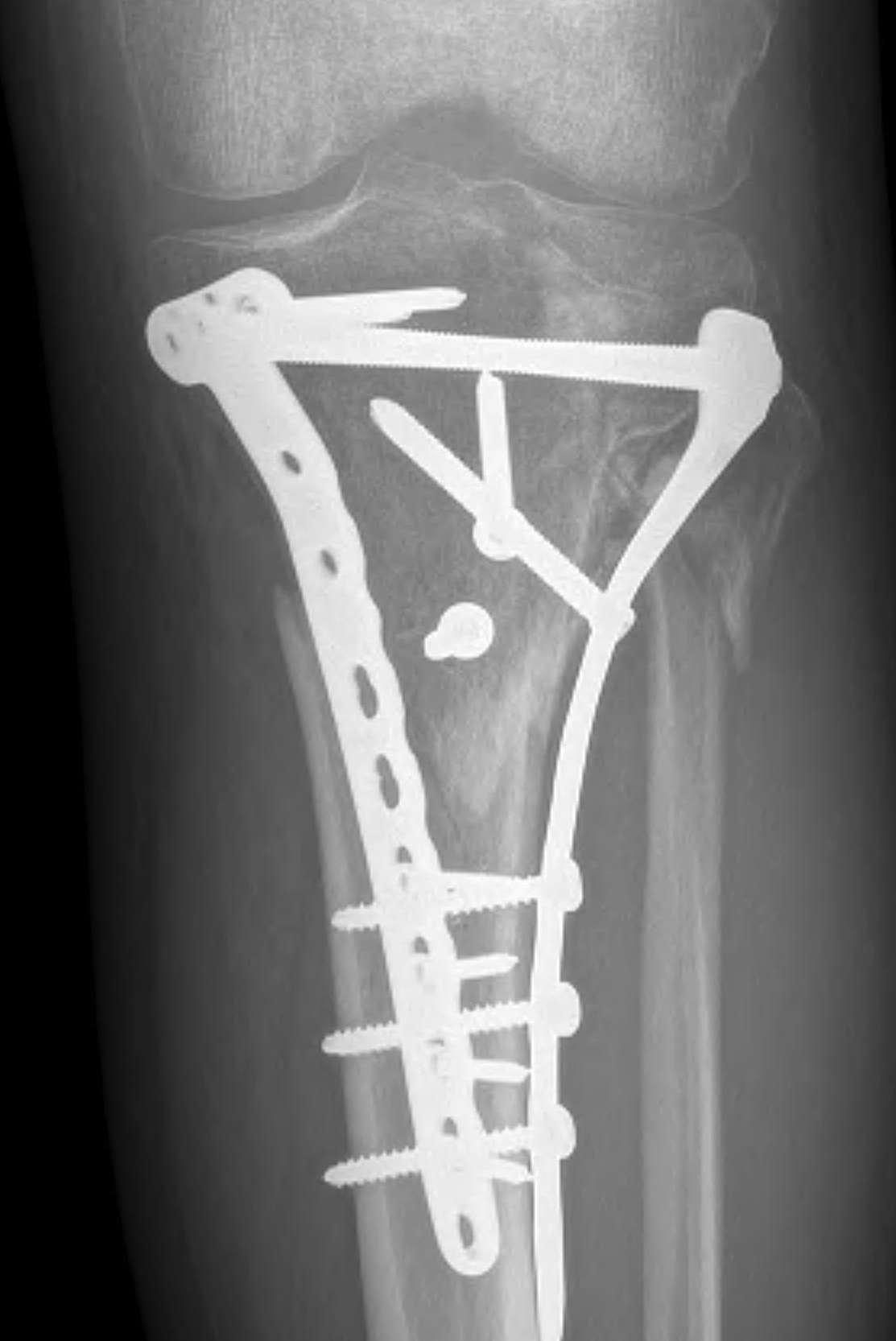 Tibial Plateau Malunion